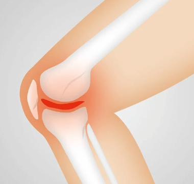 무릎관절염 치료